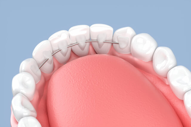 裏側矯正（舌側矯正）の仕組みと表側矯正との違い